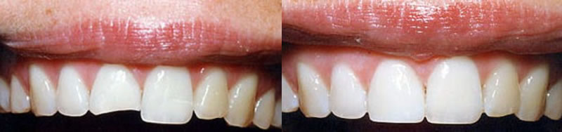 Before-After Cosmetic Bonding