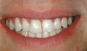 After Cosmetic Bonding- Smile Gallery