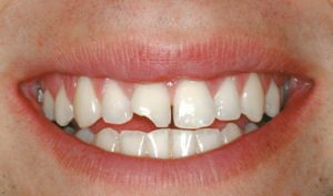 Before Cosmetic Bonding- Smile Gallery