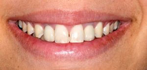 After Dental Bridge- Smile Gallery