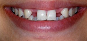 Before Dental Bridge- Smile Gallery