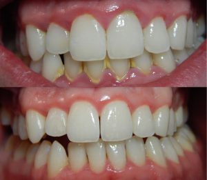 Before-After Dental Cleaning