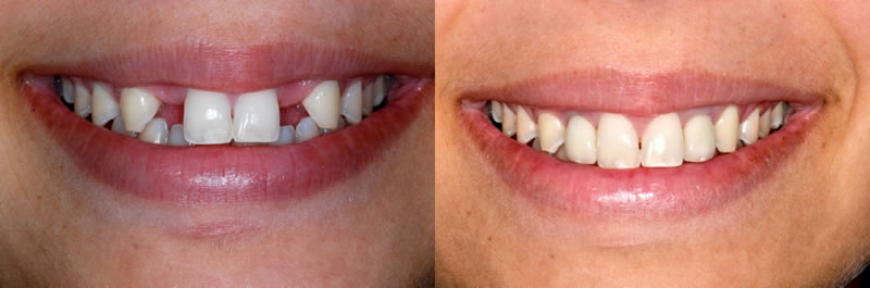 Before-After Dental Crowns
