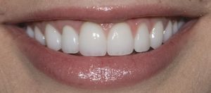 After Dental Crown- Smile Gallery