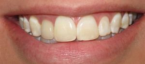 Before Dental Crown- Smile Gallery