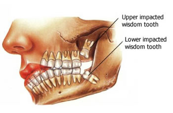 Wisdom Tooth Extraction-Thornhill Family Dental