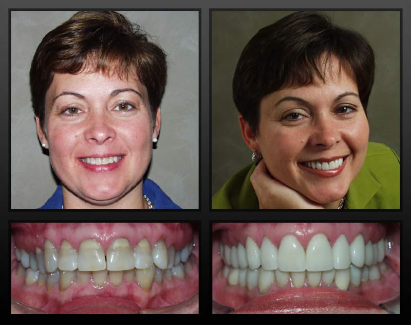 Full Mouth Rehabilitation- Thornhill Family Dental