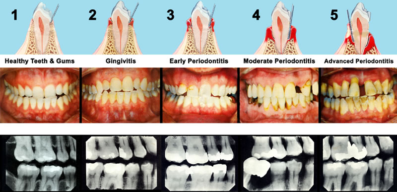 Gum Disease Therapy Procedure
