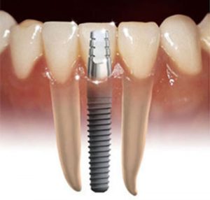 Dental Implants- Thornhill Family Dental