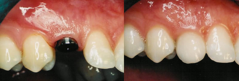 Before-After Implant Dentistry