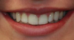 After Dental Implants- Smile Gallery