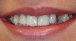 Before Dental Implants- Smile Gallery