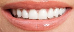 After Porcelain Veneers- Smile Gallery