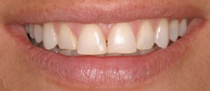 Before Porcelain Veneers- Smile Gallery