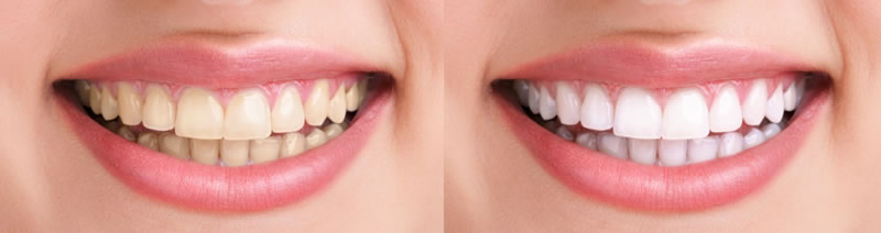 Before-After Teeth Whitening