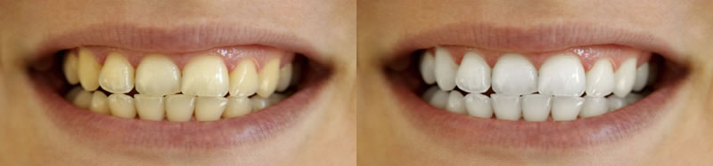 Teeth Whitening-Thornhill Family Dental