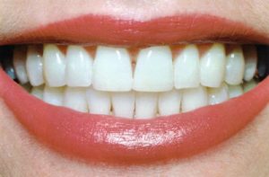 After Teeth Whitening- Thornhill Family Dental