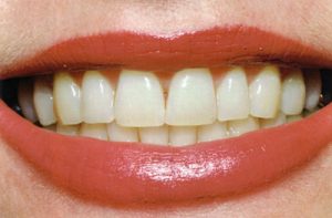 Before Teeth Whitening- Thornhill Family Dental