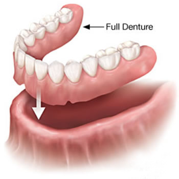 Full Dentures- Thornhill FAmily Dental